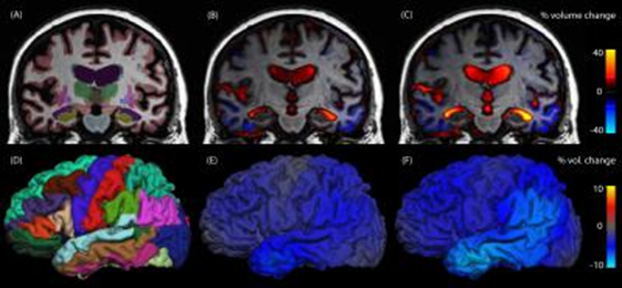 Structural Changes in the Brain